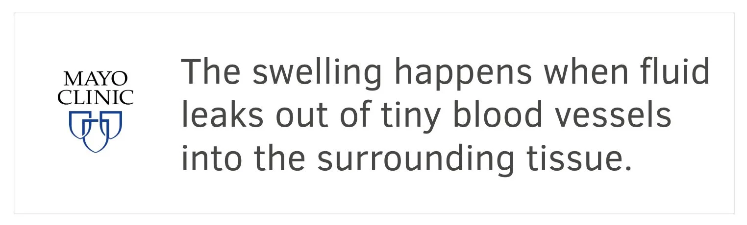 Mayo Clinic: the swelling happens when fluid leaks out of tiny blood vessels into the surrounding tissue